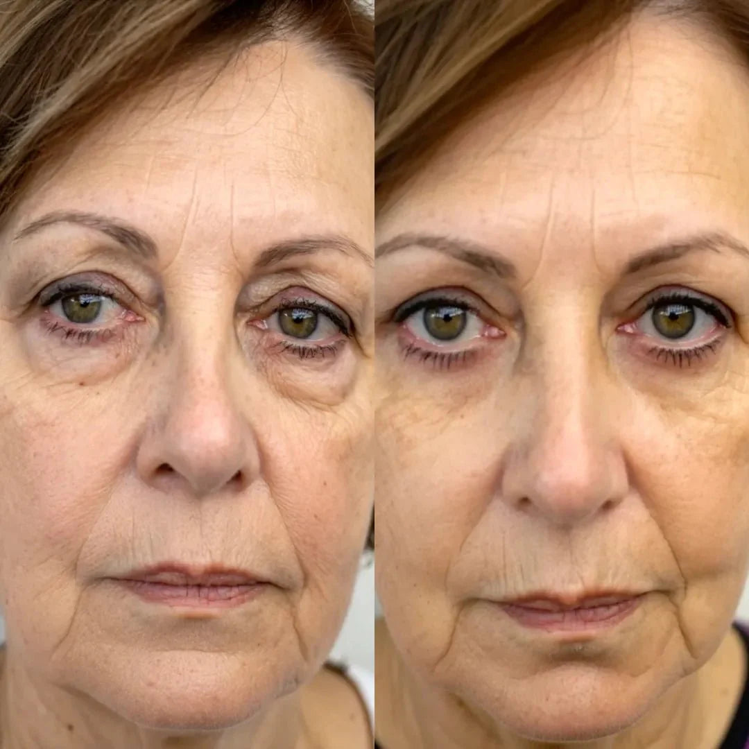 2-en-1 Terapia de Luz Roja + EMS para eliminar ojeras